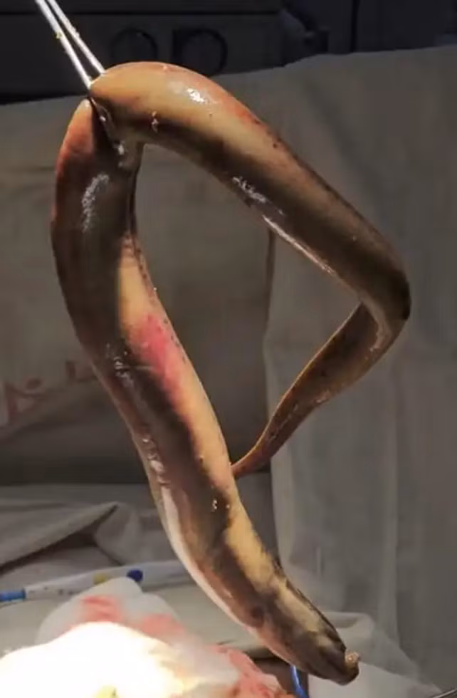 eel-surgically-removed-from-human.jpg