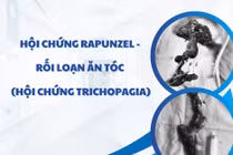 Lấy khối tóc lớn trong dạ dày bé 7 tuổi thích ăn tóc