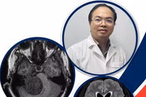 Mổ lấy thai bóc tách u não thành công cho sản phụ mang thai lần 5