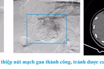Đau chướng bụng do u gan chảy máu tràn dịch màng bụng