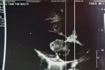 U nhầy tim- thủ phạm thầm lặng gây đột quỵ ở người trẻ