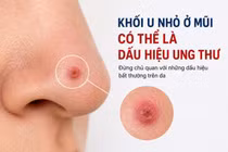 Phát hiện sớm ung thư da từ mụn nhỏ trên mũi 