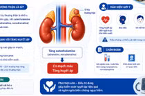 U tủy thượng thận- nguyên nhân nguy hiểm gây tăng huyết áp, đột quỵ 