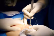 Công nghệ định vị không dây giúp phát hiện, xử lý tổn thương vú siêu nhỏ