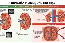 Đau lưng kéo dài, người đàn ông 45 tuổi phát hiện ung thư thận