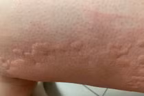 Mày đay cấp bùng phát mùa Tết, đừng chủ quan những mảng đỏ 'nở rộ' trên da