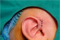 Nhiễm trùng tai tái diễn, cẩn thận dò luân nhĩ ở trẻ cần phẫu thuật