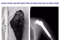 Thay khớp vai đảo ngược, giữ lại cánh tay cho bệnh nhi 14 tuổi ung thư xương
