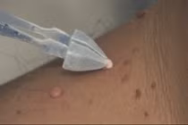 Cách chăm sóc da sau điều trị liệu pháp lạnh