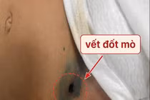 Sốt 5 ngày, bé gái 2 tuổi thoát khỏi sốc nhiễm khuẩn nhờ phát hiện vết đốt mò