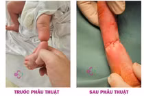 Bé sơ sinh 12 giờ tuổi nguy cơ tổn thương chân do vòng xơ thắt nghẹt