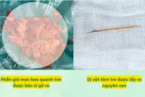 Bé trai nguy kịch vì tràn mủ màng tim, bác sĩ phát hiện tăm tre xuyên thất phải
