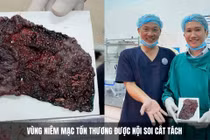 Rối loạn tiêu hóa phát hiện tổn thương tiền ung thư trực tràng