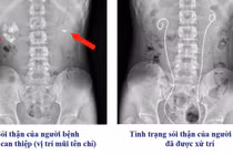 Gallery - Chỉ thấy nặng bụng, người phụ nữ kinh nguyệt đều phát hiện u xơ tử cung 17 cm - image 2