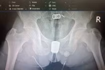 Dị vật trực tràng mắc sâu phải mổ mở để xử lý thành công
