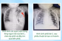 Ho kéo dài, bé gái 17 tháng tuổi phát hiện thoát vị hoành hiếm gặp