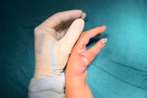 Phẫu thuật cái hóa giúp trẻ thiểu sản ngón cái tìm lại chức năng bàn tay