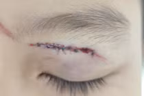 Mới nghỉ hè, trẻ liên tiếp nhập viện vì tai nạn sinh hoạt 