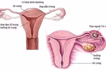 Người phụ nữ 36 tuổi sốc mất máu do chửa ngoài tử cung vỡ