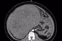 Chưa lập gia đình người phụ nữ phát hiện u sarcoma tử cung nặng gần 9 kg
