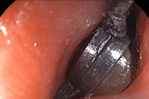 Nuốt nhiều viên nam châm, bé 5 tuổi tổn thương đường tiêu hóa