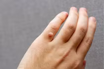 Mụn hạt cơm tưởng lành tính nhưng có thể gây nguy hiểm