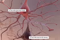 Biến chứng đa dây thần kinh ngoại biên do đái tháo đường có nguy hiểm?
