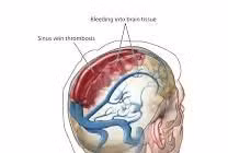 Ai có nguy cơ mắc huyết khối tĩnh mạch não?