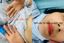 Đau chướng bụng 2 ngày, phát hiện u trong lòng ruột do bệnh di truyền