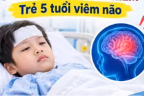 Trẻ 5 tuổi viêm não hoại tử do cúm A: Cảnh giác sốt cao, nói sảng