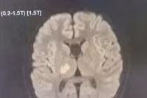 Bất ngờ trẻ 13 tuổi đang khỏe mạnh thì đột quỵ
