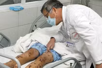 Phát hiện 1 ca mắc viêm não mô cầu ở Hà Nội