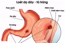 Nguy cơ sức khỏe từ trào lưu mì cay 7 cấp độ