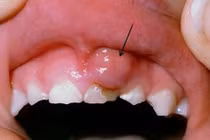 Điều khủng khiếp xảy ra do lười đánh răng nhiều ngày