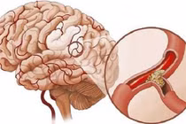 3 triệu chứng khó chịu khi ngủ cảnh báo bệnh nhồi máu não