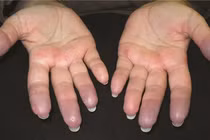 Nhiệt độ xuống thấp “phi mã” gây hại cho cơ thể thế nào?
