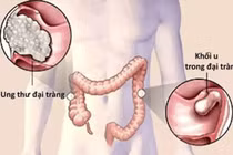 Bé 9 tuổi ung thư đại trực tràng, thói quen ăn uống tai hại
