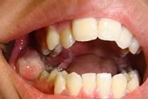 Sau nhổ răng khôn, thanh niên 18 tuổi ung thư đầy mồm gây sốc