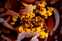 Bé gái 6 tuổi người Mỹ tử vong do các biến chứng của virus SARS-CoV-2