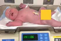 Bé sơ sinh chào đời đã nặng 6,5 kg, gấp 3 trẻ bình thường
