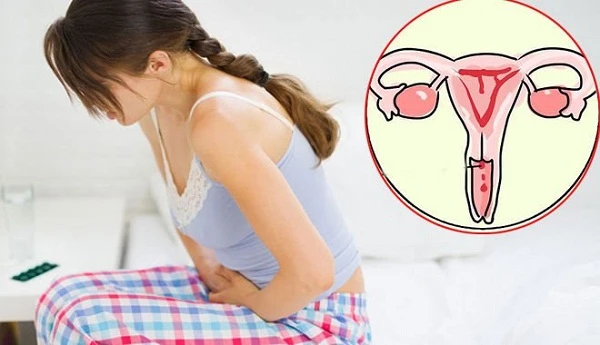 2 dấu hiệu trên quần lót chỉ ra tử cung có vấn đề