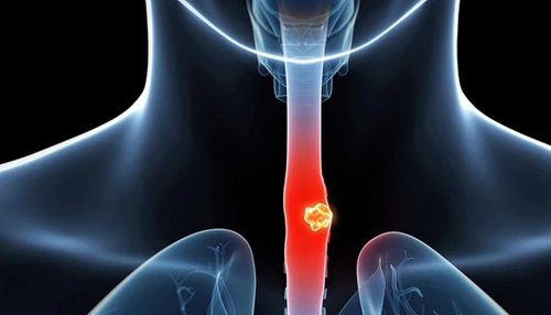 4 kiểu ăn phổ biến, sớm muộn gây ung thư thực quản