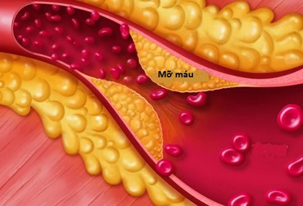 Kinh ngạc loại rau gây mỡ máu không kém thịt, người bệnh tránh xa