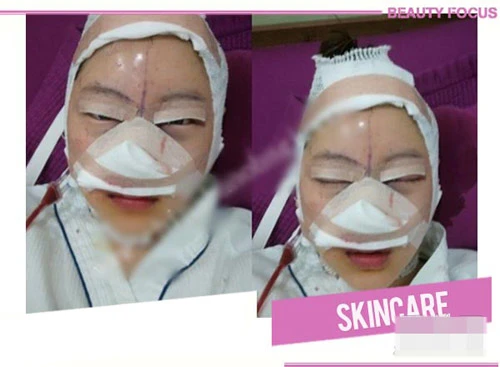 Những hình ảnh hết hồn về sửa mũi