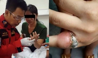 Cận cảnh ngón tay viêm lở khủng khiếp vì đeo nhẫn chật