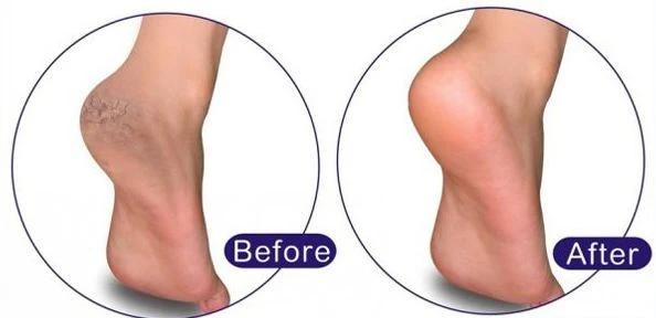 Trị nứt gót chân dễ dàng với baking soda và nước ấm