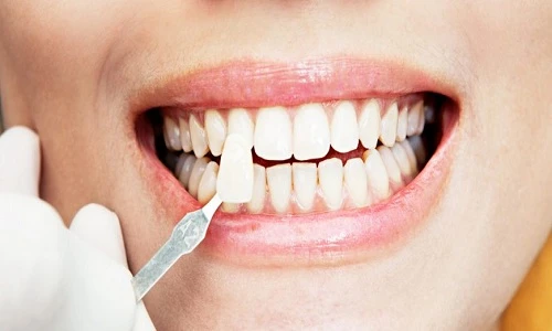 Làm đẹp với răng sứ Veneer cần chú ý điều gì? 