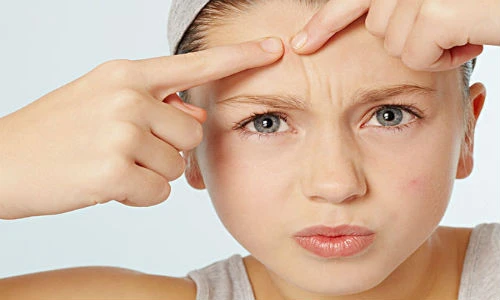 Không muốn mặt bung bét, đừng làm điều này khi bị mụn 