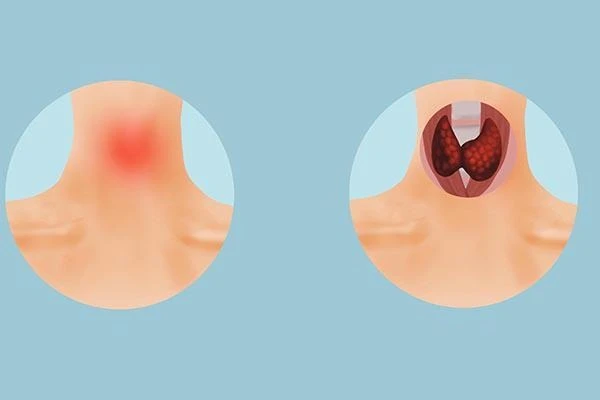 Cách phân biệt u lành hay ác tính ở cổ