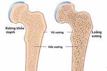 Nguyên nhân khiến nhiều người trẻ mắc bệnh loãng xương